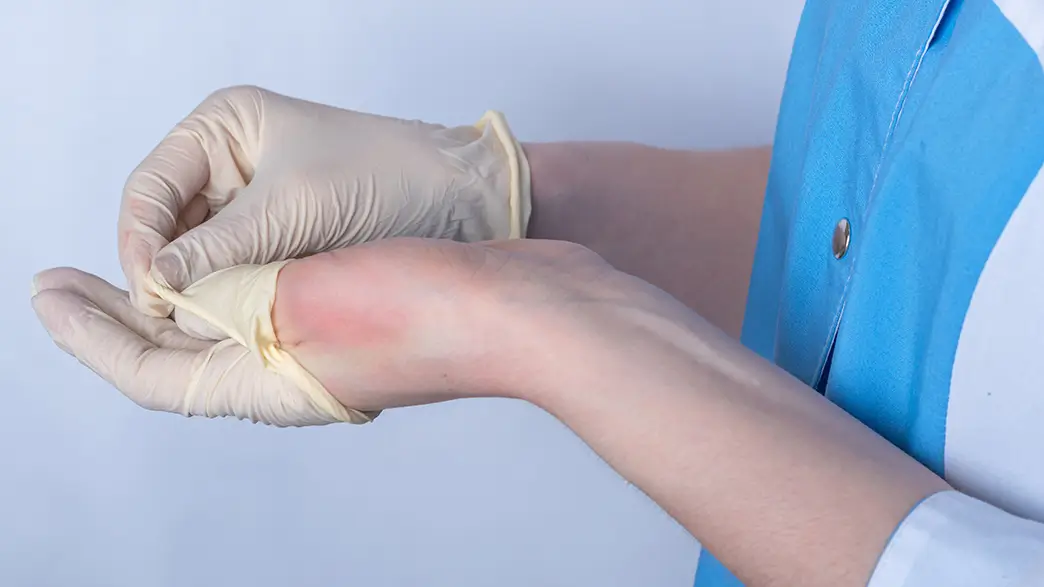 Latexhandschuhe können unangenehme und schwere Kontaktallergien hervorrufen Eine junge Frau zieht Latexhandschuhe aus und unter den Handschuhen kommt gerötete Haut zum Vorschein, womöglich als Folge einer Latexallergie